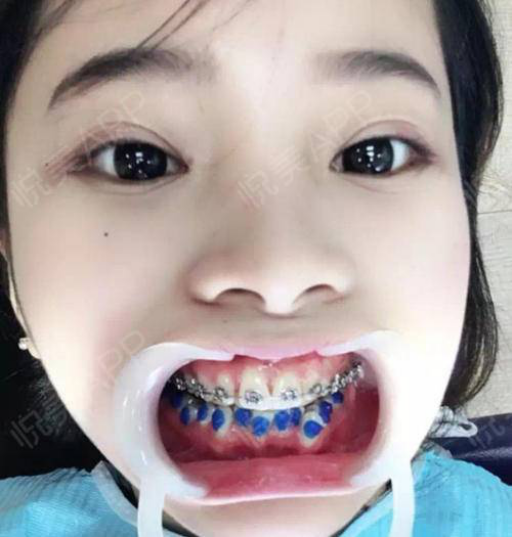 补的牙掉了一块怎么办;补的牙掉了一块怎么办拿什么补